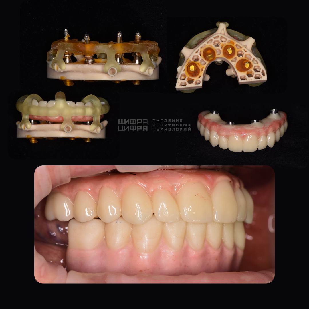 Продвинутый курс. Разборные хирургические шаблоны в RealGUIDE ...