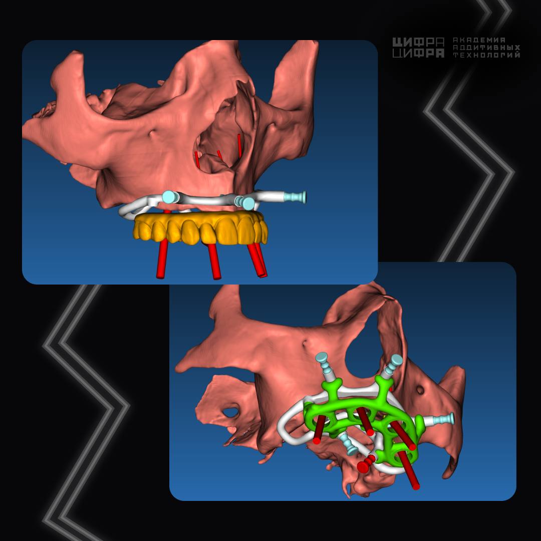 Продвинутый курс. Разборные хирургические шаблоны в RealGUIDE ...